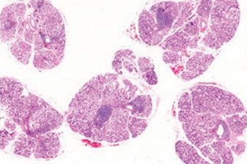 Imagen: Microfotografía de una glándula salival que muestra los sitios de inflamación indicativos del síndrome de Sjögren (Fotografía cortesía del Instituto Nacional de Investigación Dental y Craneofacial de los EUA).
